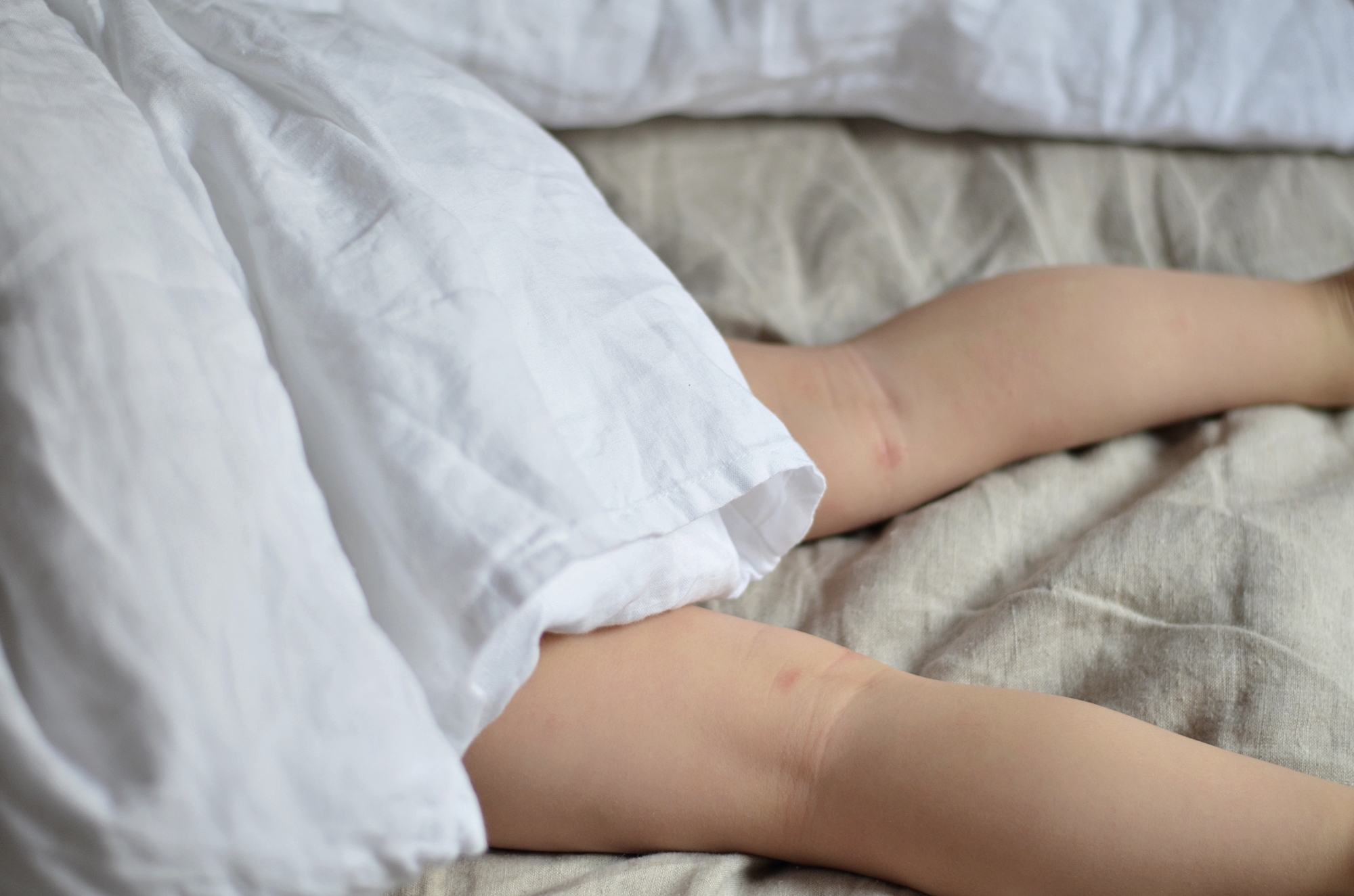 JAK LECZYĆ ATOPOWE ZAPALENIE SKÓRY U DZIECI